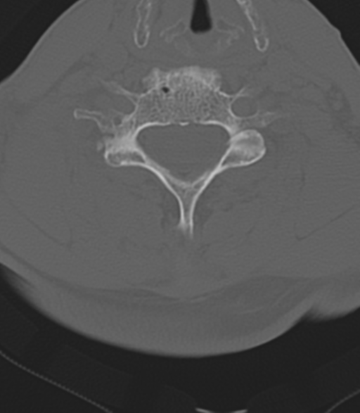 File:Cervical spine fractures with vertebral artery dissection (Radiopaedia 53296-59268 Axial bone window 37).png