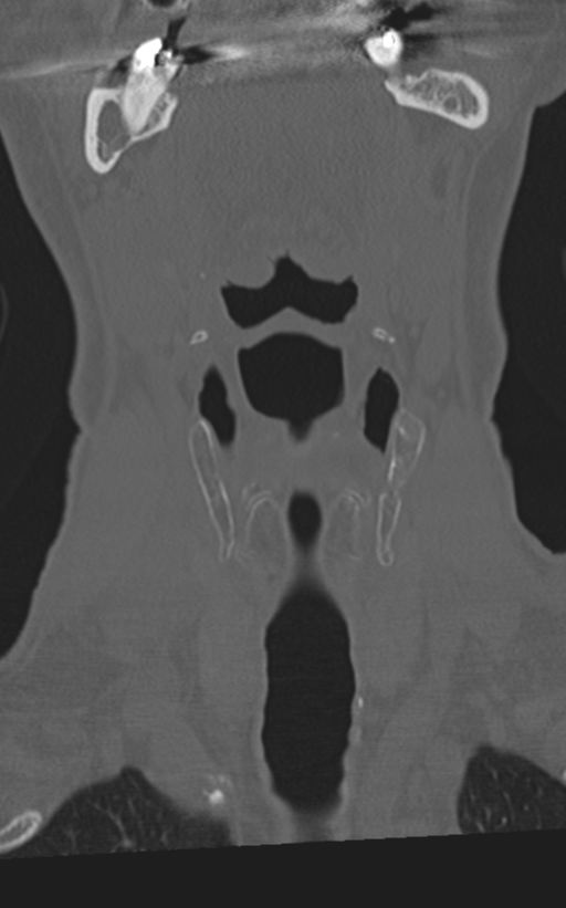 Cervical spine fractures with vertebral artery dissection (Radiopaedia 53296-59268 Coronal bone window 8).png