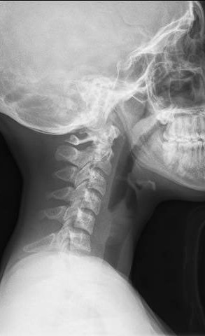 File:Cervical spine posterior ligamentous complex rupture (Radiopaedia 63486-72100 Lateral 1).jpg