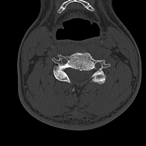 Cervical spondylodiscitis (Radiopaedia 28057-29489 Axial bone window 41).jpg