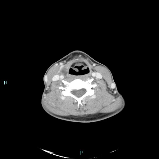 Cervical thymic cyst (Radiopaedia 88632-105335 C 55).jpg