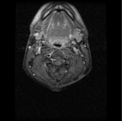 File:Cervical vertebrae metastasis (Radiopaedia 78814-91667 Axial T1 C+ fat sat 3).png