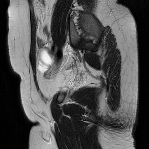 File:Cesarean scar ectopic pregnancy (Radiopaedia 77286-89362 Sagittal T2 7).jpg