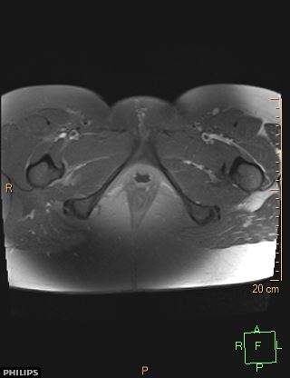 File:Cesarian scar endometriosis (Radiopaedia 68495-78066 Axial T1 C+ fat sat 27).jpg