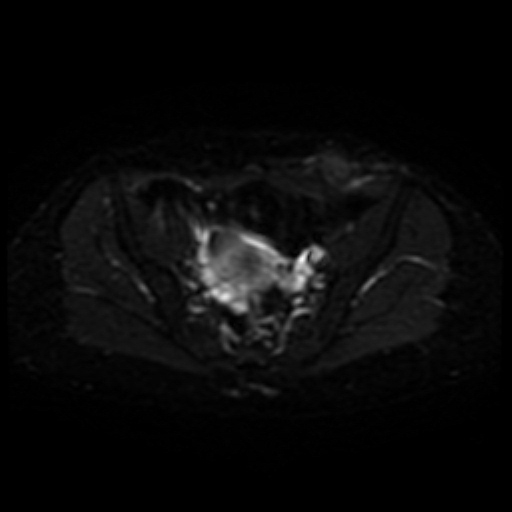 File:Cesarian section scar endometriosis (Radiopaedia 66520-75799 Axial DWI 9).jpg