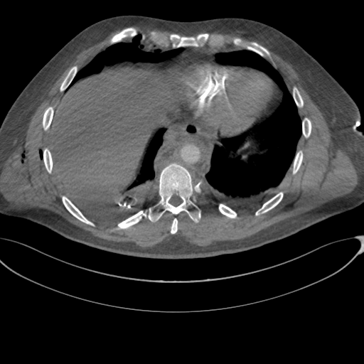 File:Chest multitrauma - aortic injury (Radiopaedia 34708-36147 A 226).png