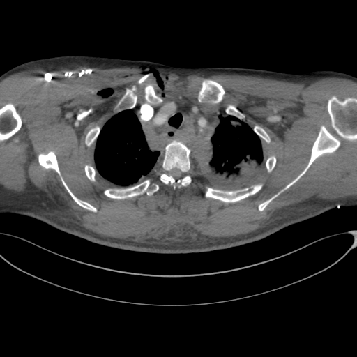 File:Chest multitrauma - aortic injury (Radiopaedia 34708-36147 A 55).png