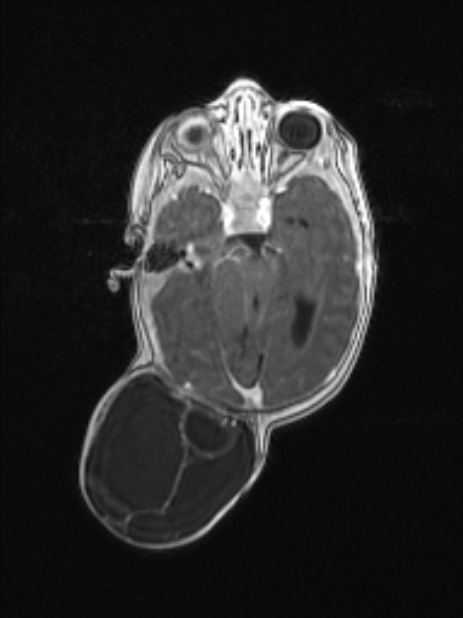 Chiari III malformation with occipital encephalocele (Radiopaedia 79446-92559 Axial T1 C+ mpr 41).jpg