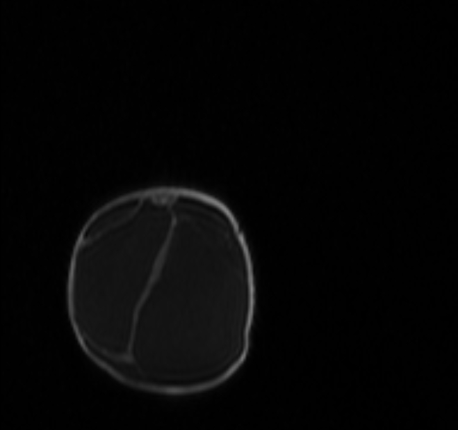 Chiari III malformation with occipital encephalocele (Radiopaedia 79446-92559 Coronal T1 C+ mpr 67).jpg