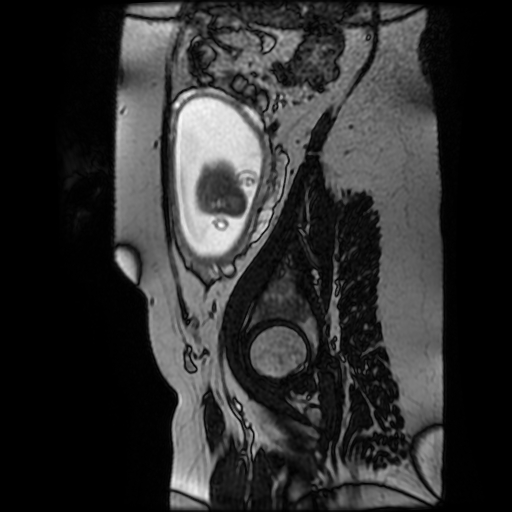 Chiari II malformation - fetal MRI (Radiopaedia 68099-77581 Sagittal Fiesta 9).jpg