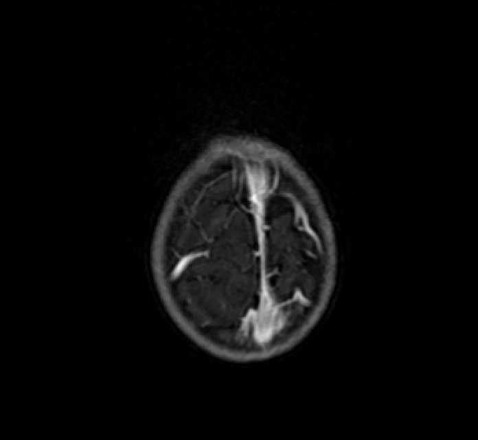 Chiasmatic-hypothalamic glioma (Radiopaedia 90079-107252 Axial T1 C+ 85).jpg