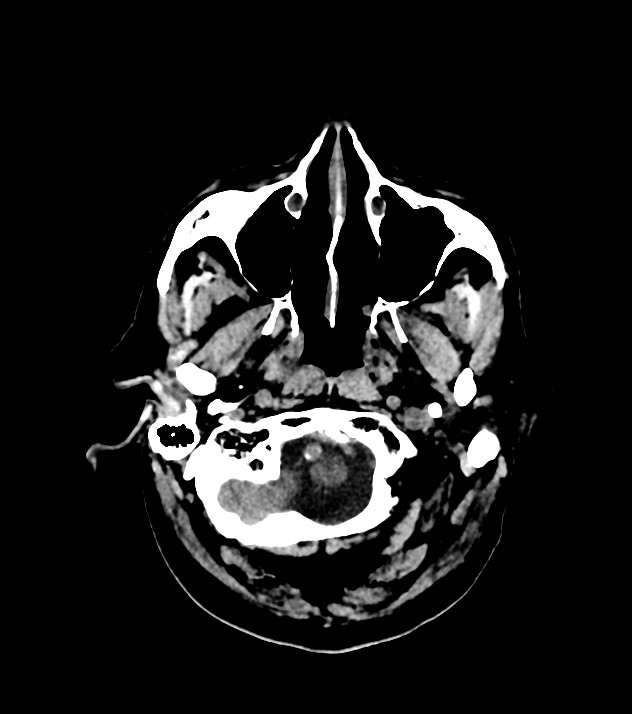 Cholangiocarcinoma with cerebral metastases (Radiopaedia 83519-98628 Axial non-contrast 12).jpg