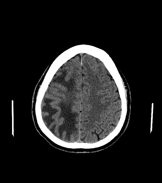 Cholangiocarcinoma with cerebral metastases (Radiopaedia 83519-98628 Axial non-contrast 50).jpg
