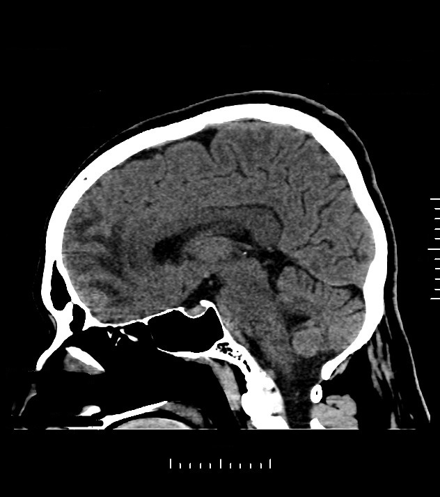 Cholangiocarcinoma with cerebral metastases (Radiopaedia 83519-98628 C 29).jpg