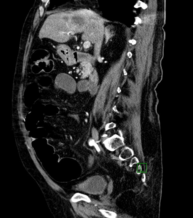 Cholangiocarcinoma with cerebral metastases (Radiopaedia 83519-98629 F 72).jpg