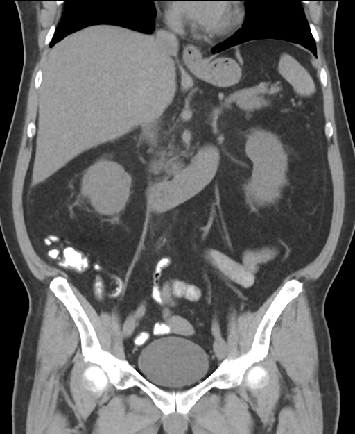 Cholecystitis with focal perforation and hepatic abscess (Radiopaedia 37189-38945 Coronal non-contrast 30).png