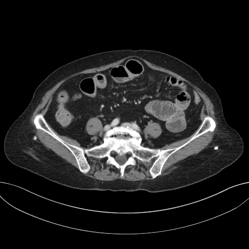 Cholecystoduodenal fistula due to calculous cholecystitis with gallstone migration (Radiopaedia 86875-103077 D 54).jpg