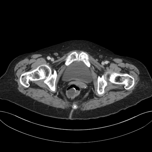 Cholecystoduodenal fistula due to calculous cholecystitis with gallstone migration (Radiopaedia 86875-103077 D 79).jpg