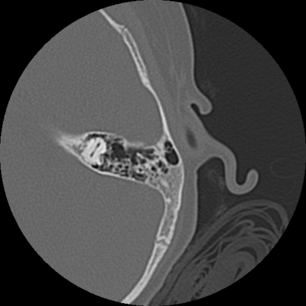Cholesteatoma (Radiopaedia 73023-83750 Axial Left ear 65).jpg