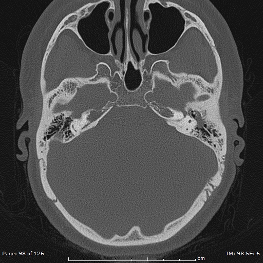 Cholesteatoma - external auditory canal (Radiopaedia 88452-105096 Axial bone window 61).jpg