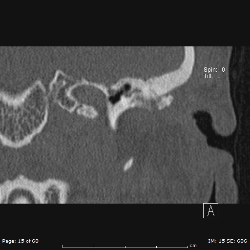 File:Cholesteatoma - external auditory canal (Radiopaedia 88452-105096 Coronal bone window 15).jpg