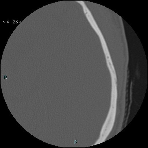 File:Cholesterol granuloma of the petrous apex (Radiopaedia 64358-73141 Axial bone window 14).jpg