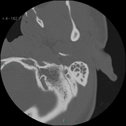Cholesterol granuloma of the petrous apex (Radiopaedia 64358-73141 Axial bone window 78).jpg