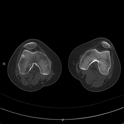 Chondroblastoma (Radiopaedia 62721-71030 Axial bone window 14).jpg
