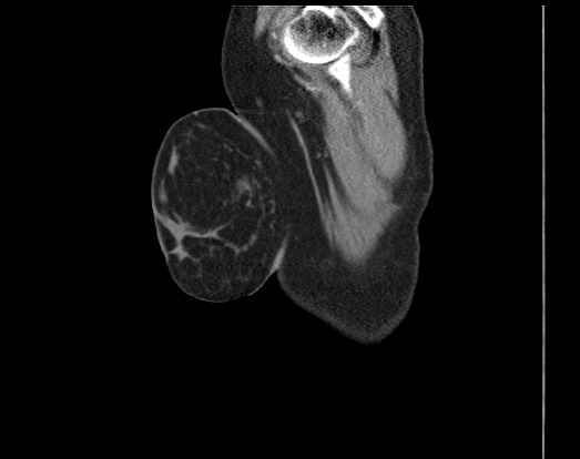 Chondrosarcoma - chest wall (Radiopaedia 65192-74199 B 1).jpg