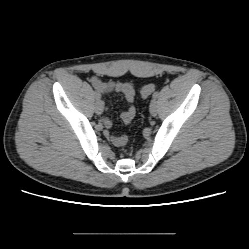 Chondrosarcoma of iliac wing (Radiopaedia 63861-72599 Axial non-contrast 75).jpg