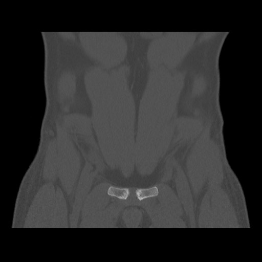 Chondrosarcoma of iliac wing (Radiopaedia 63861-72599 Coronal bone window 28).jpg