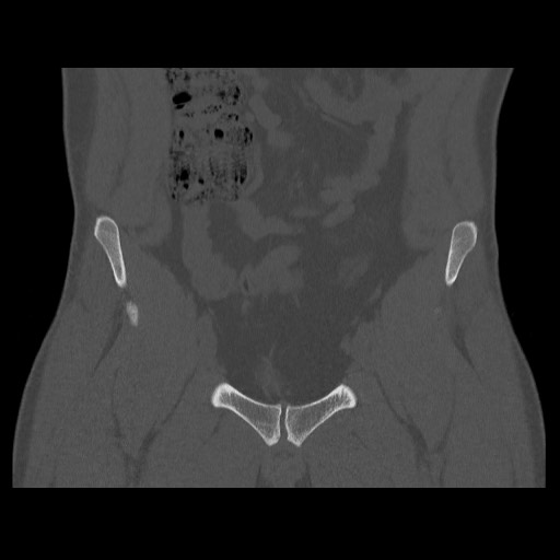 Chondrosarcoma of iliac wing (Radiopaedia 63861-72599 Coronal bone window 36).jpg