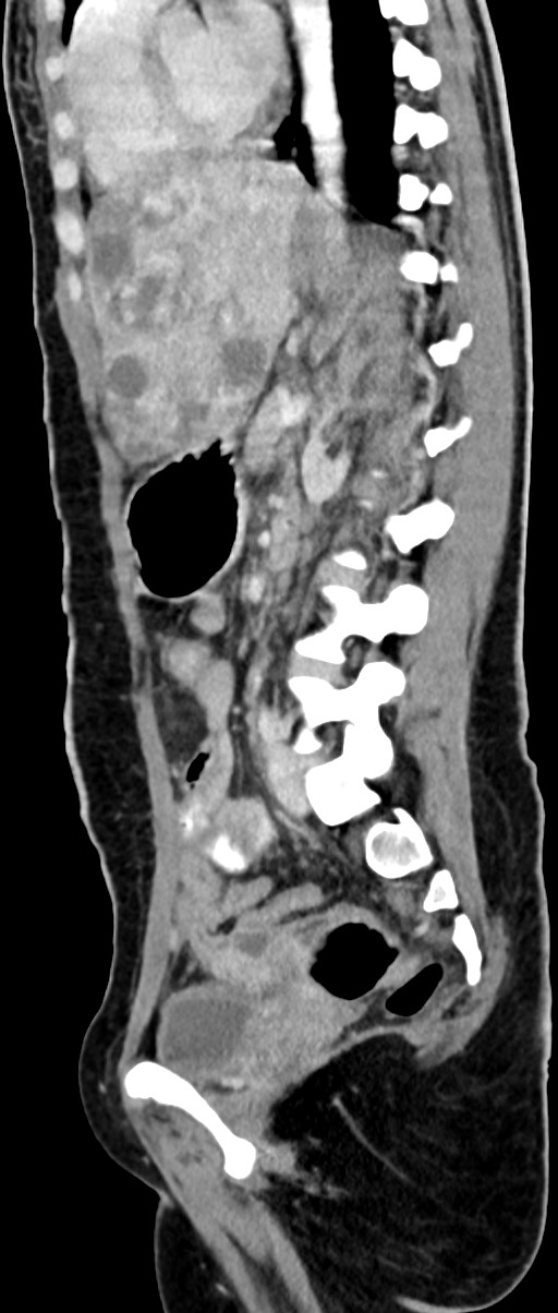 Choriocarcinoma liver metastases (Radiopaedia 74768-85766 C 87).jpg