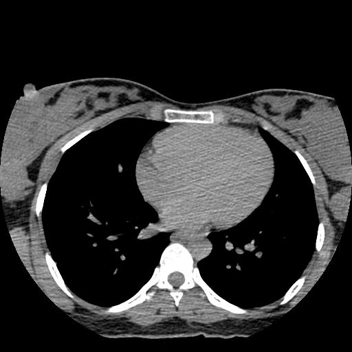 File:Choriocarcinoma of ovary with cerebral and pulmonary metastases (Radiopaedia 25983-26119 Axial non-contrast 159).jpg