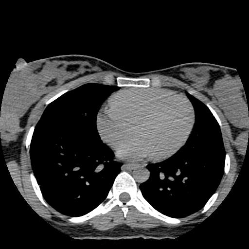 File:Choriocarcinoma of ovary with cerebral and pulmonary metastases (Radiopaedia 25983-26119 Axial non-contrast 161).jpg