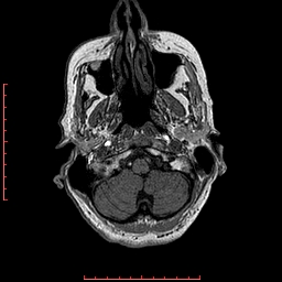 Choroid plexus xanthogranuloma (Radiopaedia 67843-77270 Axial T1 143).jpg