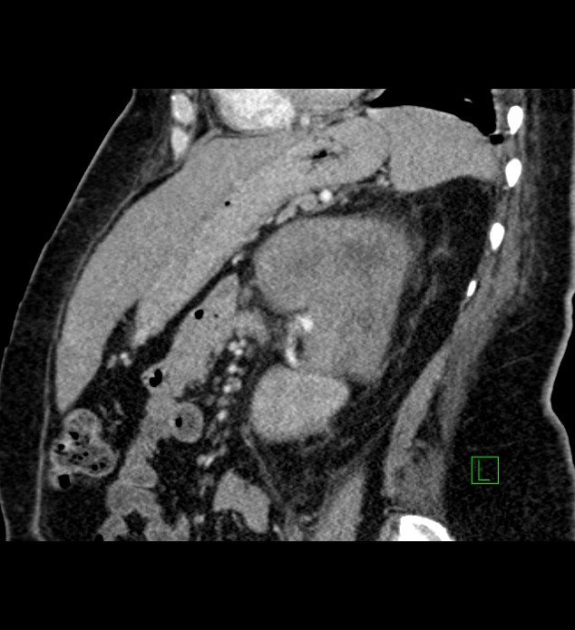 Chromophobe renal cell carcinoma (Radiopaedia 84239-99519 D 44).jpg