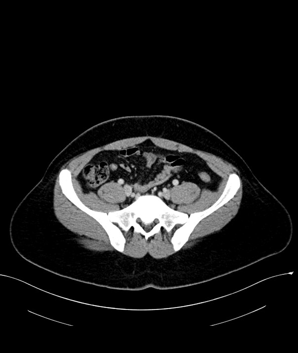 Chromophobe renal cell carcinoma (Radiopaedia 84255-99542 F 62).jpg