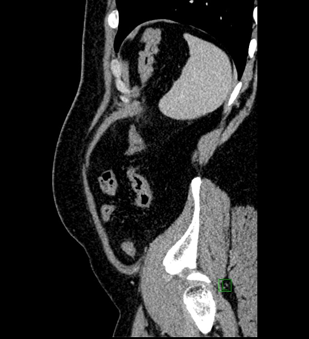 Chromophobe renal cell carcinoma (Radiopaedia 84286-99573 I 24).jpg