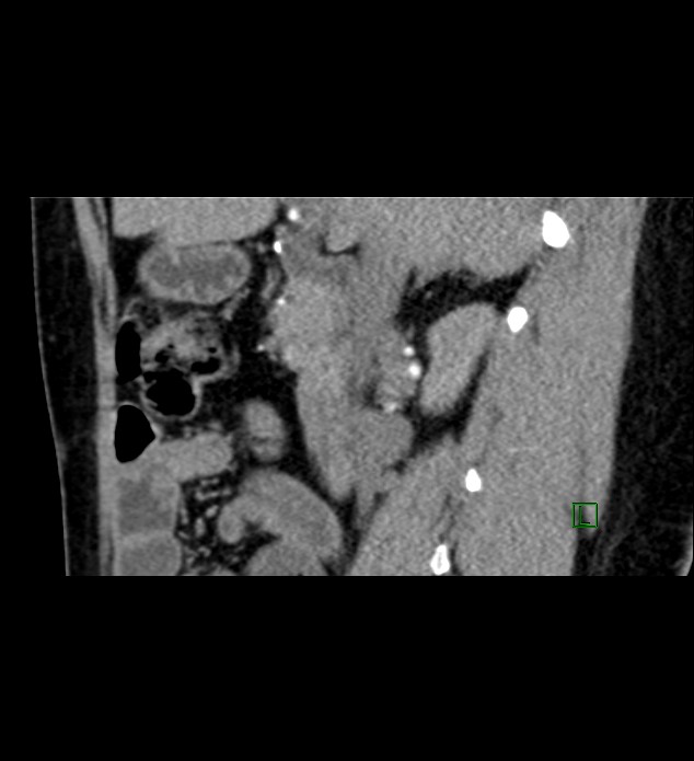 Chromophobe renal cell carcinoma (Radiopaedia 84290-99582 D 61).jpg