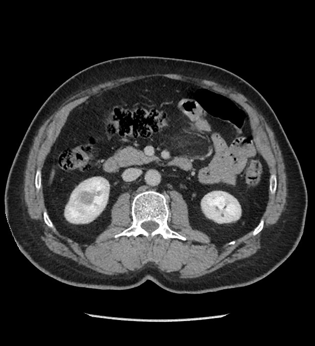 Chromophobe renal cell carcinoma (Radiopaedia 86879-103083 C 64).jpg