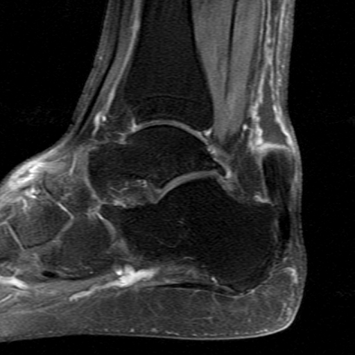 File:Chronic Achilles tendon rupture (Radiopaedia 15262-15100 C 7).jpg