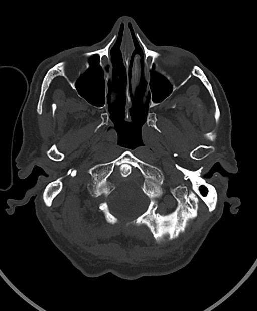 Chronic bilateral subdural hygroma (Radiopaedia 85801-101623 Axial bone window 106).jpg