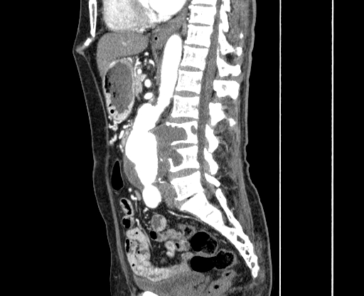 Chronic contained rupture of abdominal aortic aneurysm with extensive erosion of the vertebral bodies (Radiopaedia 55450-61901 B 33).jpg