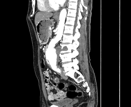 Chronic contained rupture of abdominal aortic aneurysm with extensive erosion of the vertebral bodies (Radiopaedia 55450-61901 B 38).jpg