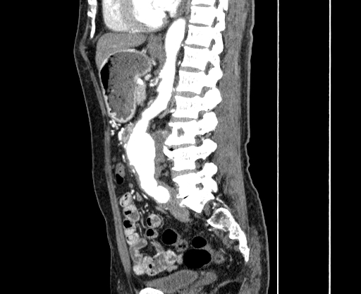 Chronic contained rupture of abdominal aortic aneurysm with extensive erosion of the vertebral bodies (Radiopaedia 55450-61901 B 40).jpg