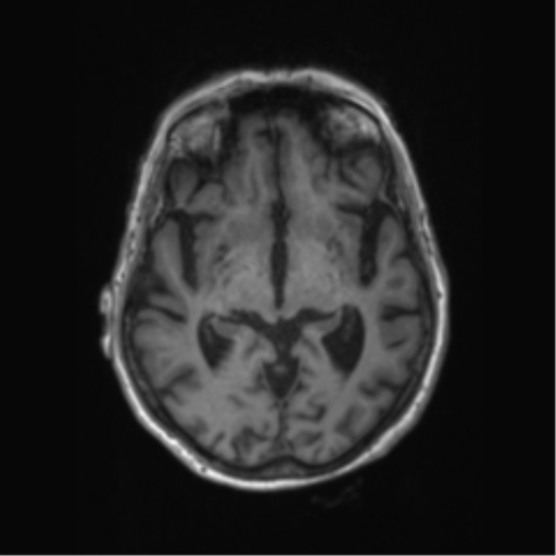 Chronic hypertensive encephalopathy (Radiopaedia 72844-83495 Axial T1 41).png