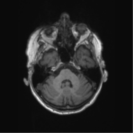 Chronic hypertensive encephalopathy (Radiopaedia 72844-83495 Axial T1 55).png