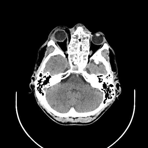 Chronic invasive fungal sinusitis (Radiopaedia 50342-55710 Axial non-contrast 44).jpg