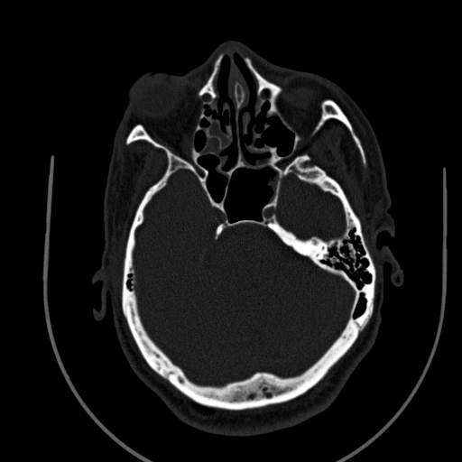 Chronic invasive fungal sinusitis (Radiopaedia 91563-109286 Axial sinus 63).jpg